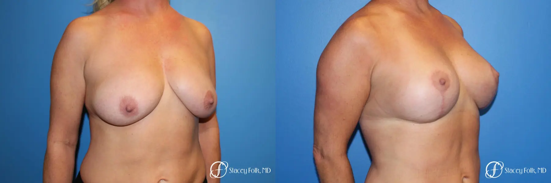 Denver Breast Lift 10252 - Before and After 4