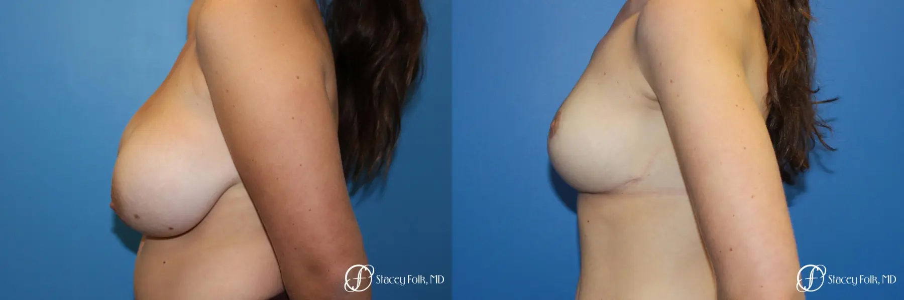 Denver Breast Lift - Mastopexy 10021 - Before and After 3