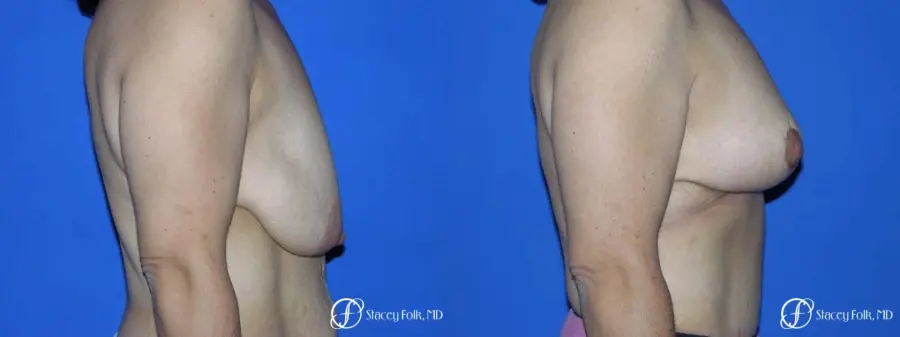 Denver Breast Lift - Mastopexy 7982 - Before and After 3