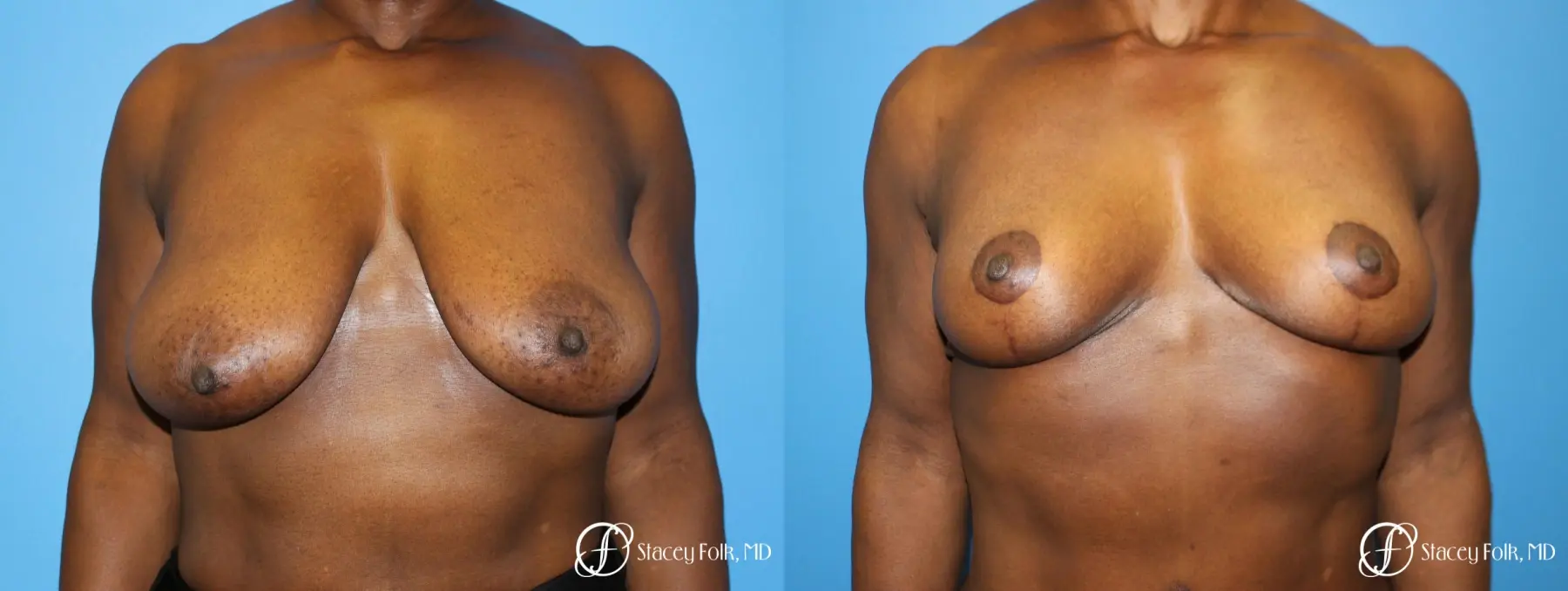 Denver Breast Lift - Mastopexy 7509 - Before and After