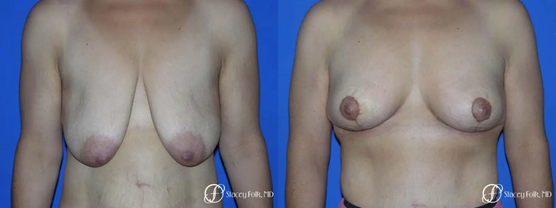 Denver Breast Lift - Mastopexy 7982 - Before and After