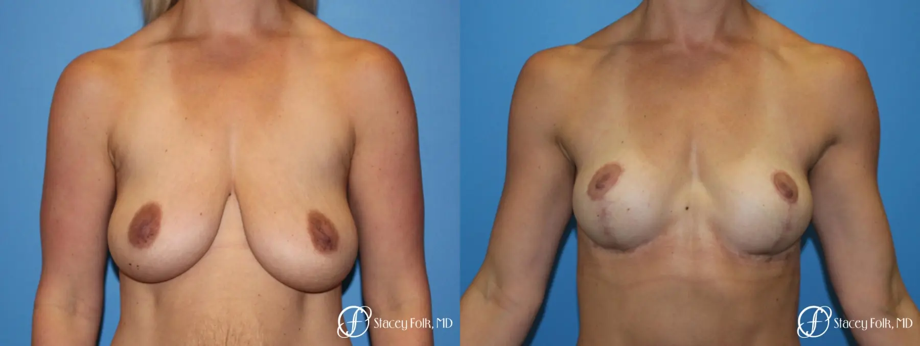 Denver Breast Lift - Mastopexy 8297 - Before and After 1