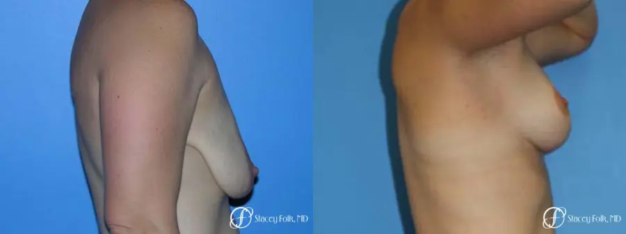 Denver Breast Lift - Mastopexy 7981 - Before and After 3