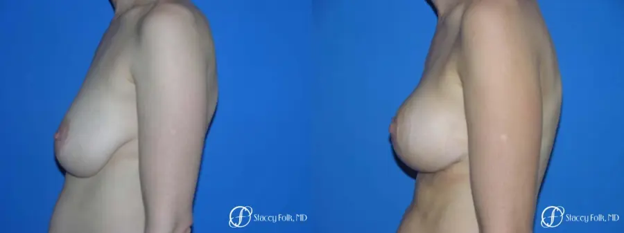 Denver Breast Lift - Mastopexy 7983 - Before and After 3