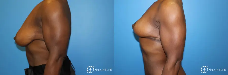 Denver Breast Reduction (Mastopexy) 7081 - Before and After 3