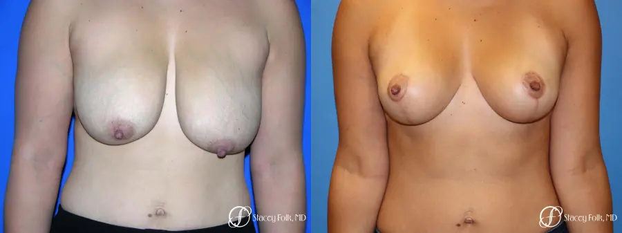 Denver Breast reduction 5842 - Before and After