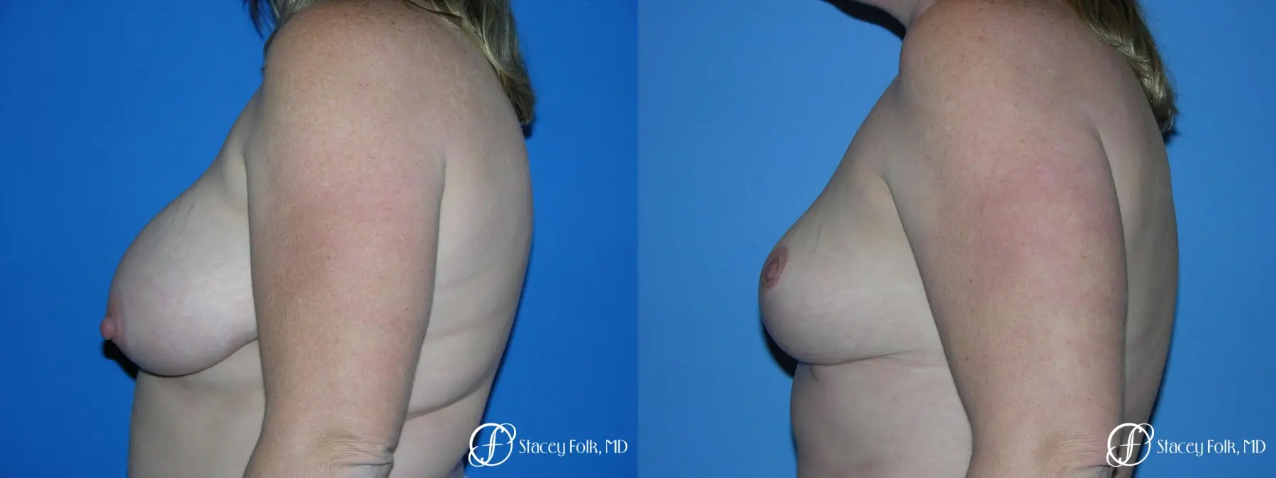 Denver Breast Reduction 4790 - Before and After 5