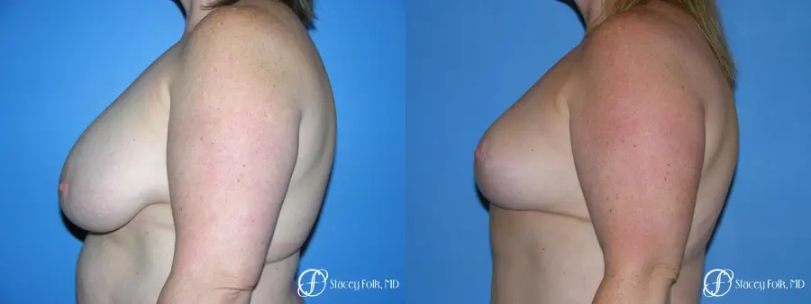 Denver Breast Reduction 4799 - Before and After 3