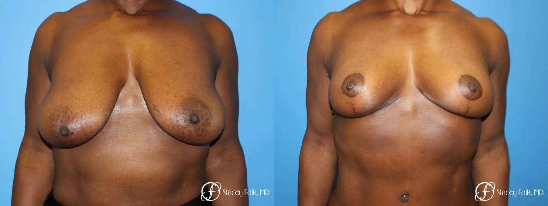 Denver Breast Reduction (Mastopexy) 7081 - Before and After 1