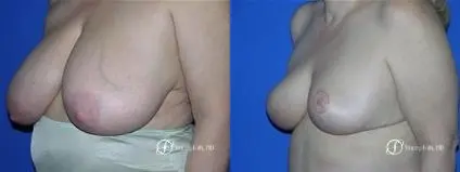 Denver Breast Reduction 16 - Before and After 2
