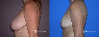 Denver Breast Reduction 14 - Before and After 3