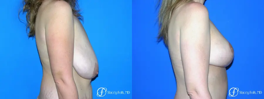 Denver Breast Reduction Mastopexy 5455 - Before and After 3