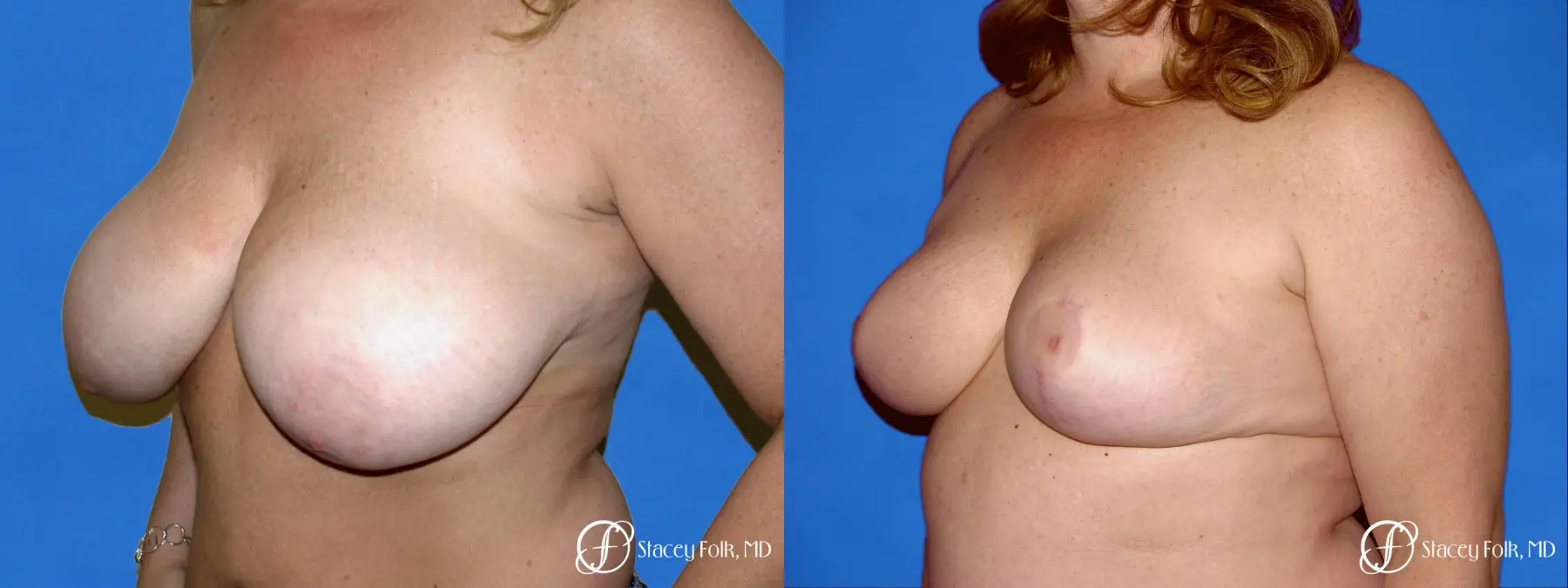Denver Breast Reduction 54 - Before and After 2