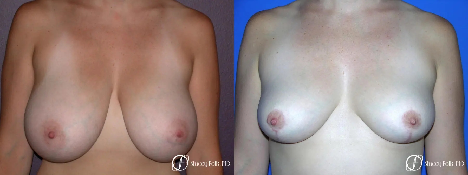 Denver Breast Reduction 42 - Before and After