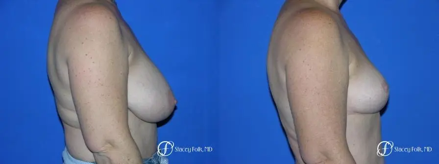 Denver Breast Reduction 36 - Before and After 3