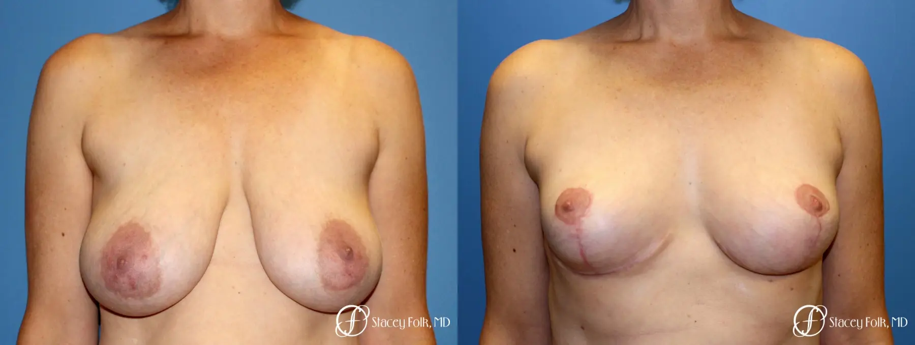 Denver Breast Reduction and Breast Lift - Mastopexy 8231 - Before and After