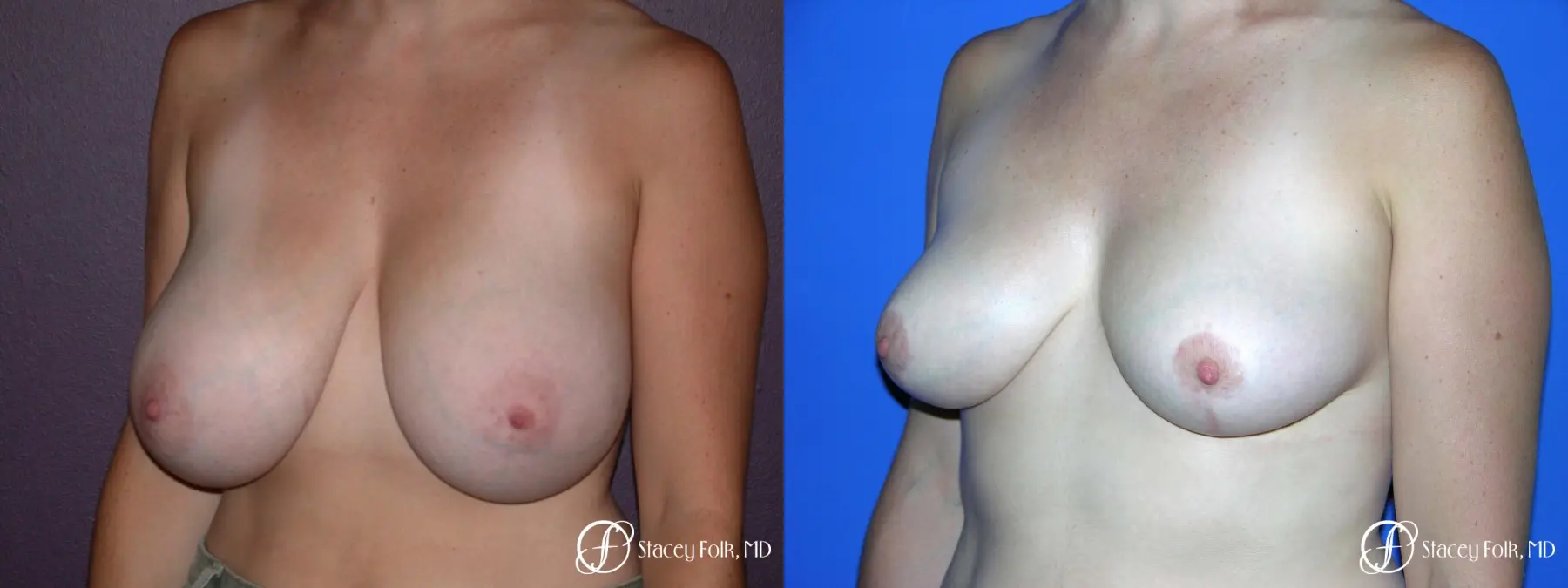 Denver Breast Reduction 42 - Before and After 2