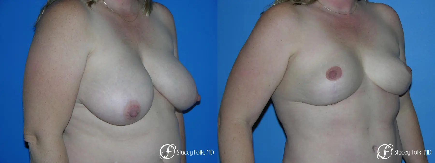 Denver Breast Reduction 4790 - Before and After 2