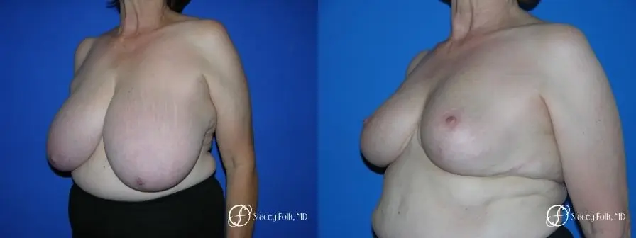 Denver Breast Reduction 37 - Before and After 2