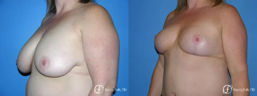 Denver Breast Reduction 4799 - Before and After 2