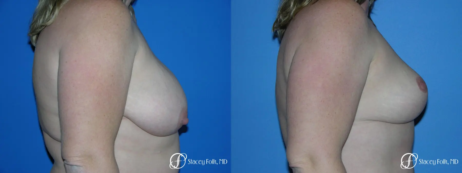 Denver Breast Reduction 4790 - Before and After 3