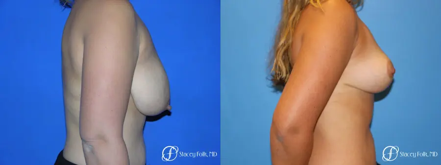 Denver Breast reduction 5842 - Before and After 3