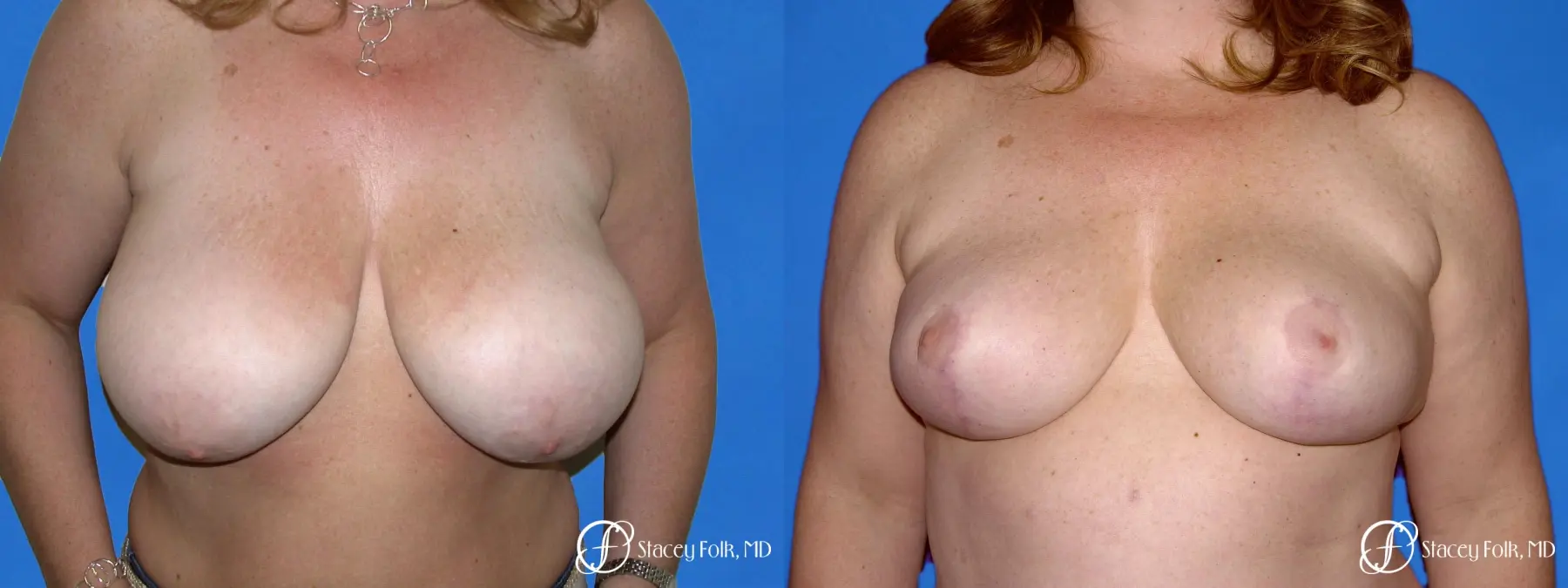 Denver Breast Reduction 54 - Before and After