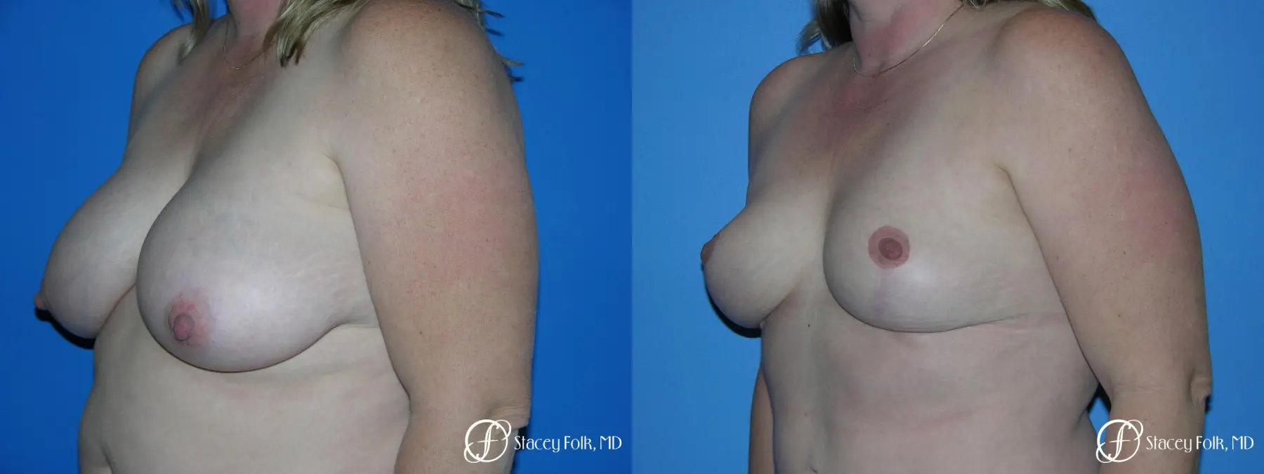 Denver Breast Reduction 4790 - Before and After 4