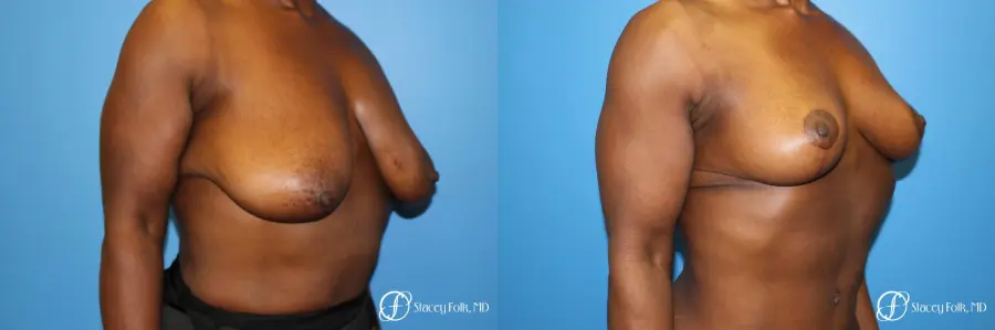 Denver Breast Reduction (Mastopexy) 7081 - Before and After 2