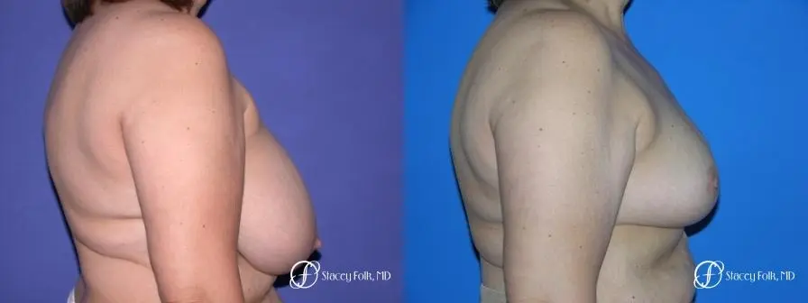 Denver Breast Reduction 55 - Before and After 2