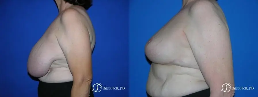 Denver Breast Reduction 37 - Before and After 3