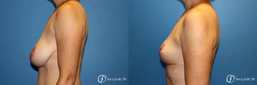 Denver Breast Reduction and Breast Lift - Mastopexy 8231 - Before and After 2