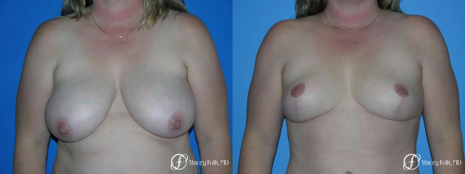 Denver Breast Reduction 4790 - Before and After
