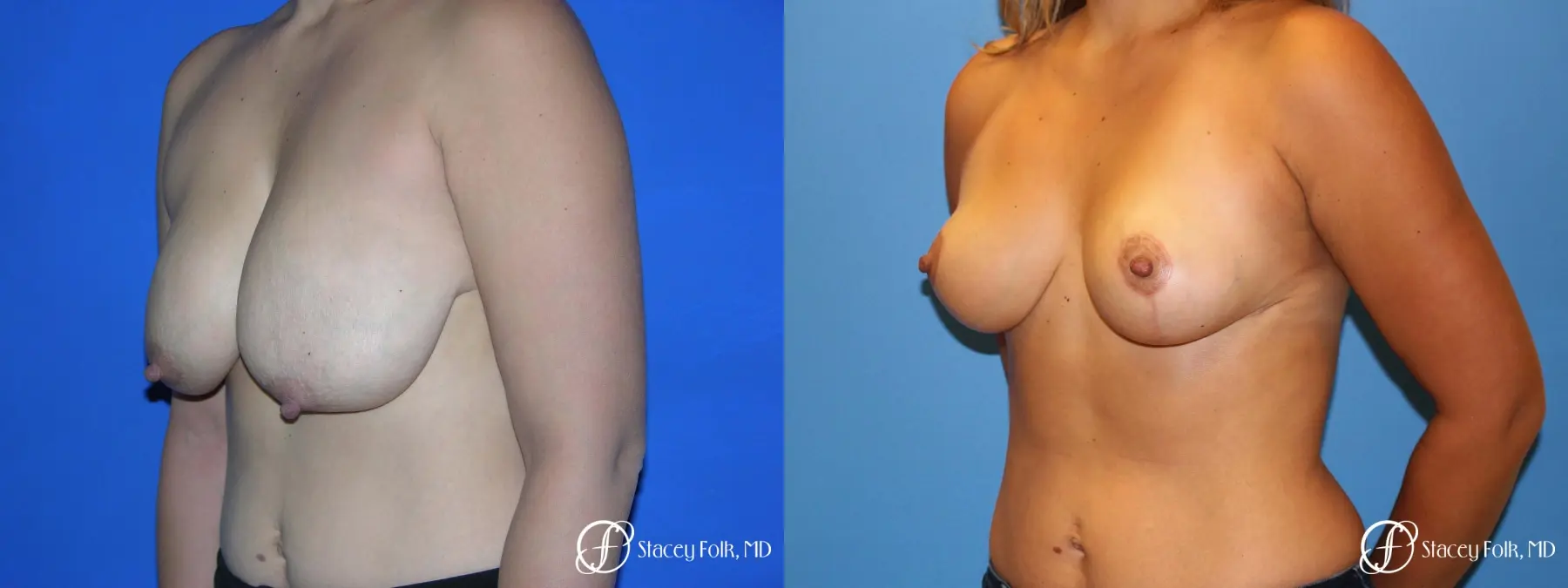 Denver Breast reduction 5842 - Before and After 2