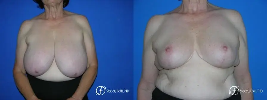 Denver Breast Reduction 37 - Before and After