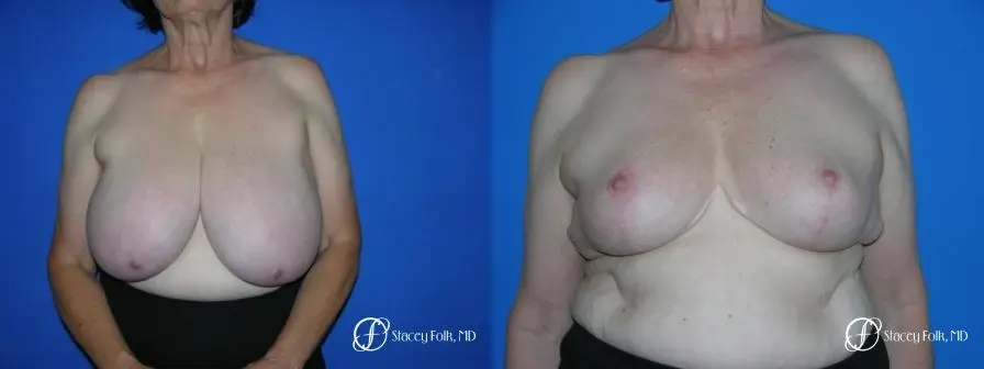 Denver Breast Reduction 37 - Before and After 1
