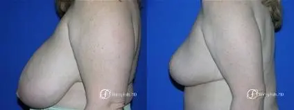Denver Breast Reduction 16 - Before and After 3