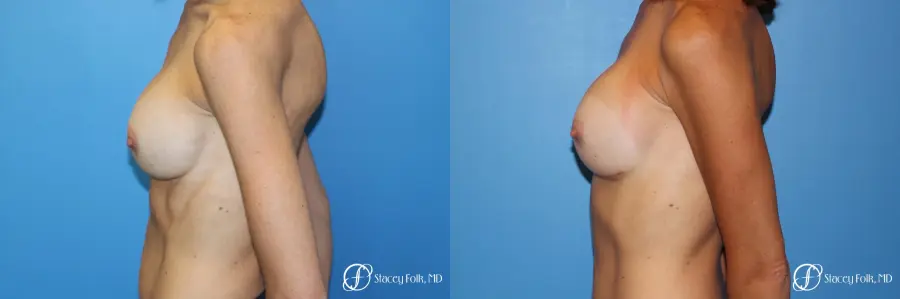 Denver Breast Revision 8504 - Before and After 4