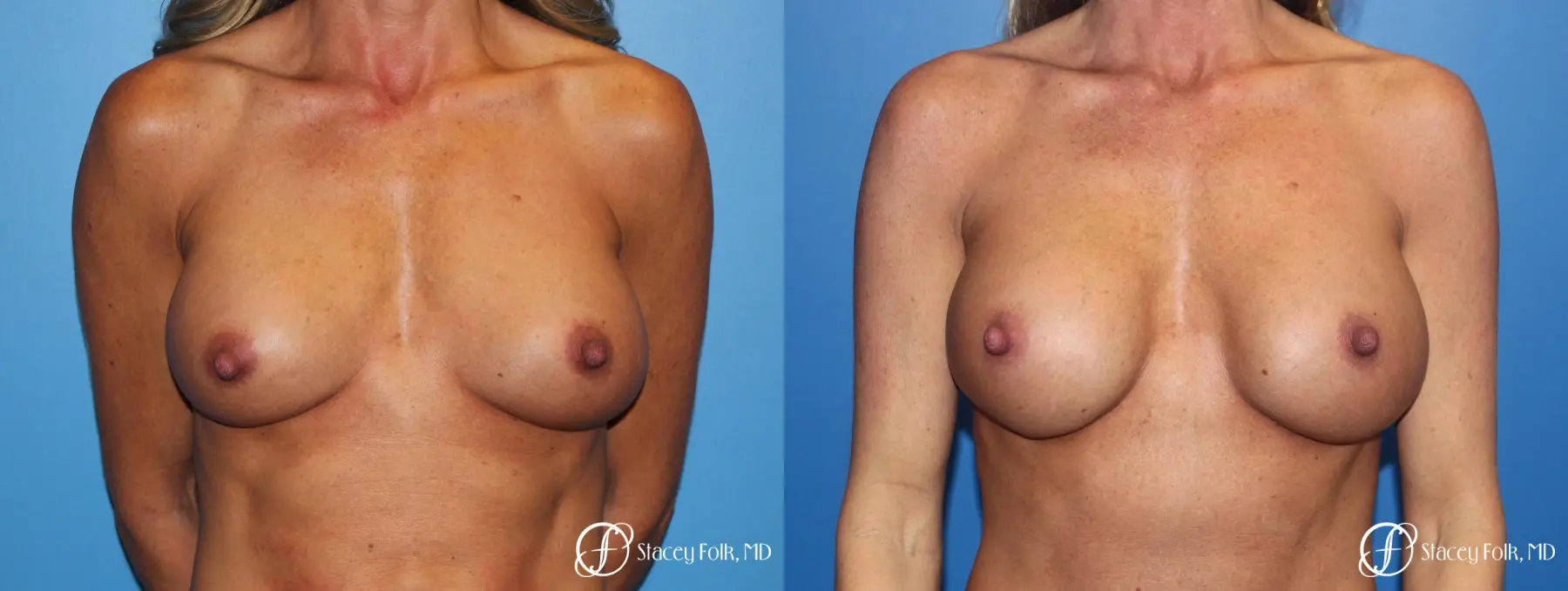 Breast Revision - Before and After