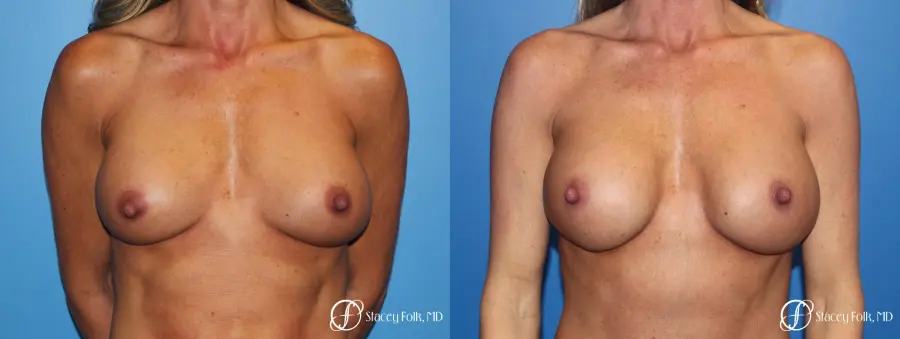 Breast Revision - Before and After 1