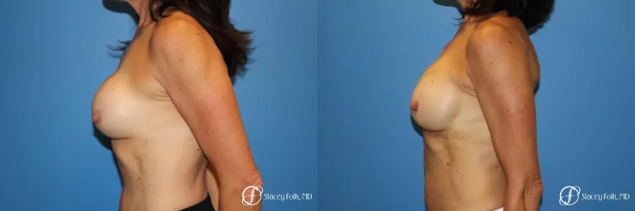 Denver Breast Revision 8272 - Before and After 2