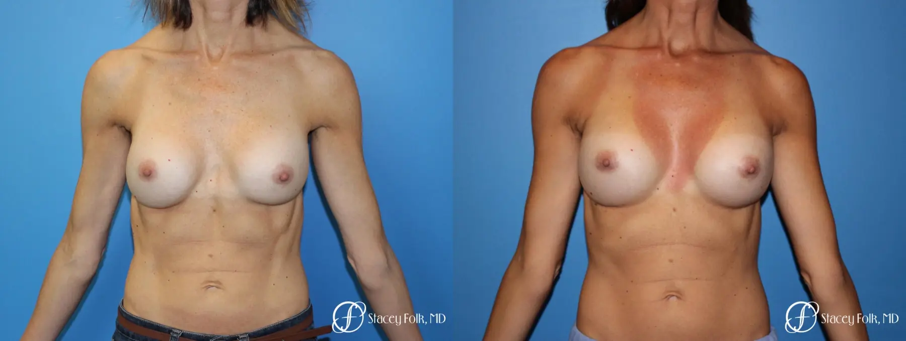 Denver Breast Revision 8504 - Before and After