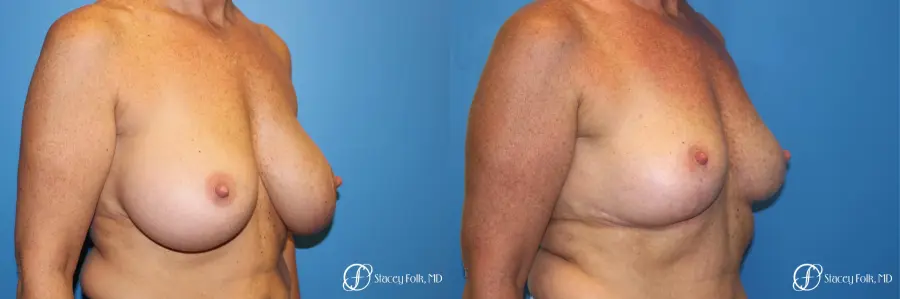 Denver Breast Revision 8543 - Before and After 2