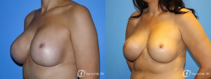 Denver Breast Revision 10094 - Before and After 2