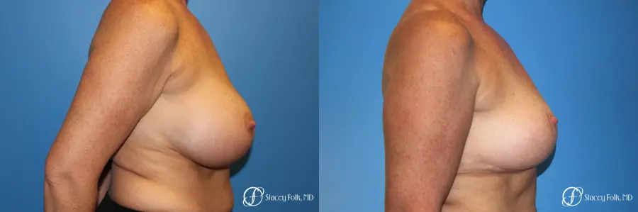 Denver Breast Revision 8543 - Before and After 3