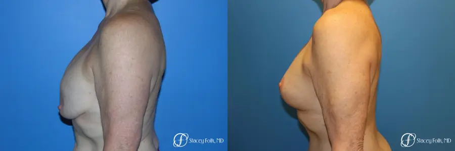 Denver Breast Revision 7990 - Before and After 3