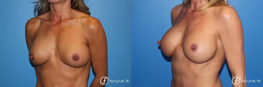 Breast Revision - Before and After 2
