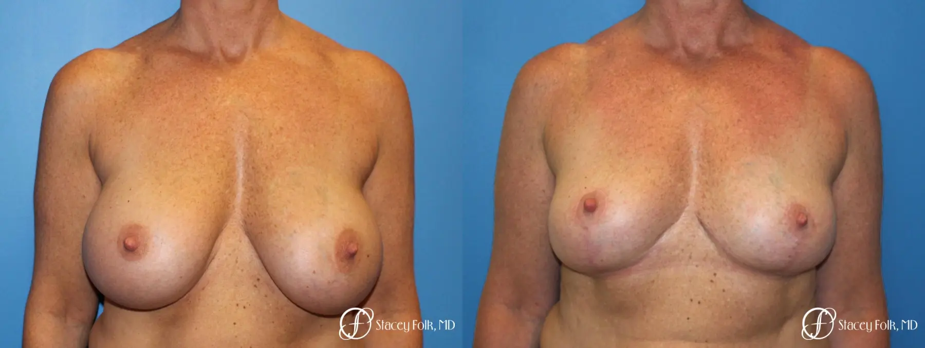 Denver Breast Revision 8543 - Before and After