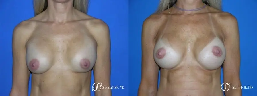Denver Breast Revision 47 - Before and After