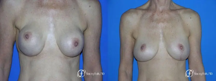 Denver Breast Revision 49 - Before and After